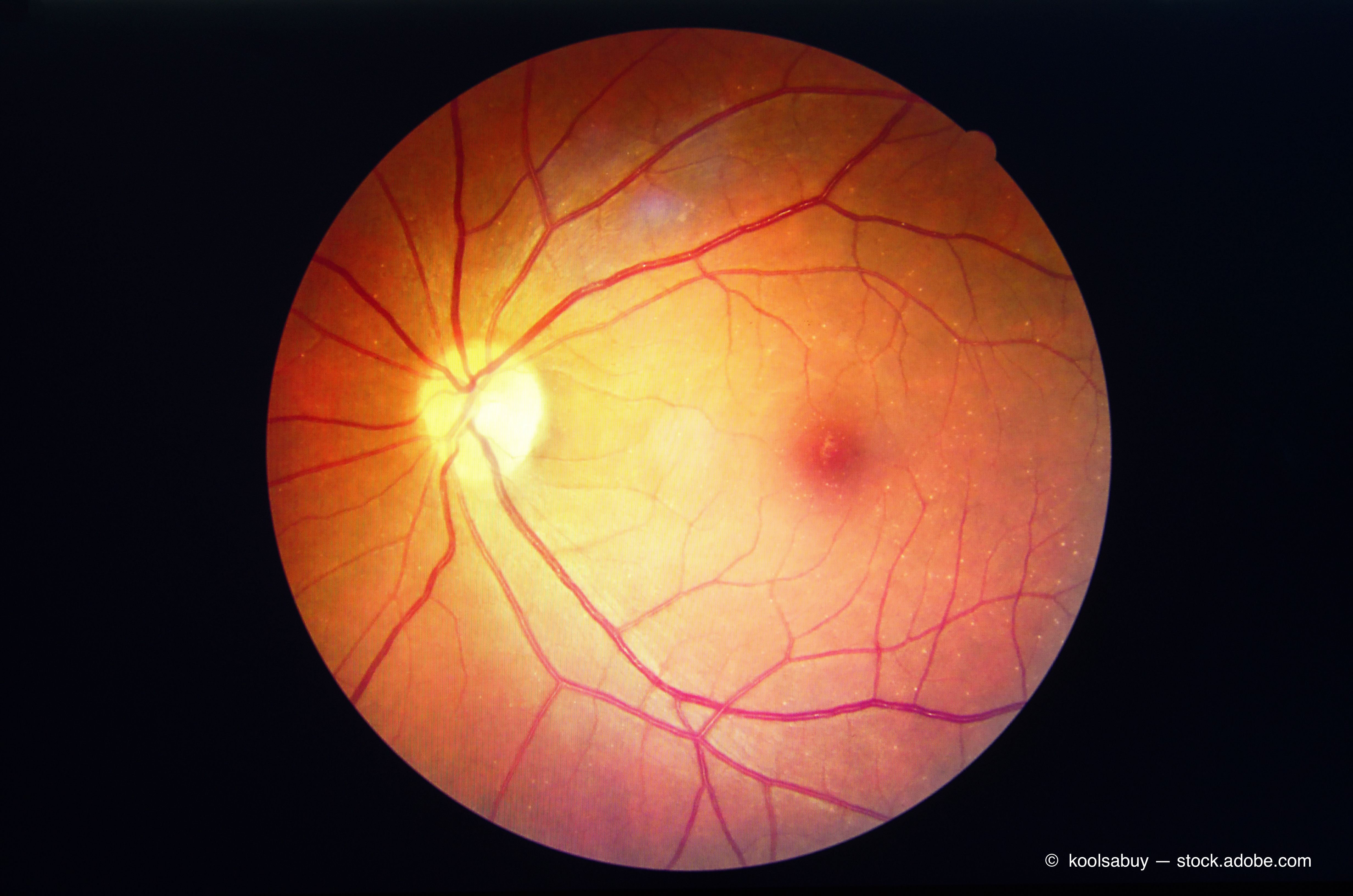 Photo of L’IA et la télé-ophtalmologie sont similaires au diagnostic de la rétinopathie diabétique