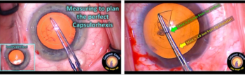 Capsulorhexis