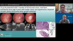 EP. 20 NeuroOp Guru: Unique case of 15-year-old who showed signs of meningioma in eye