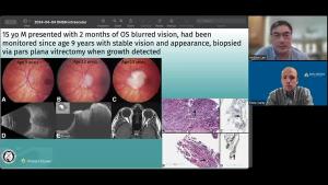 NeuroOp Guru: Unique case of 15-year-old who showed signs of meningioma in eye