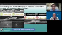 EP. 21 NeuroOp Guru: Nonleaking CRF and SRF out of proportion to optic disc edema from IIH