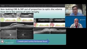 NeuroOp Guru: Nonleaking CRF and SRF out of proportion to optic disc edema from IIH