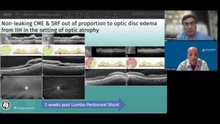 NeuroOp Guru: Nonleaking CRF and SRF out of proportion to optic disc edema from IIH