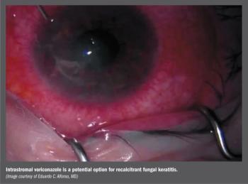 keratitis 