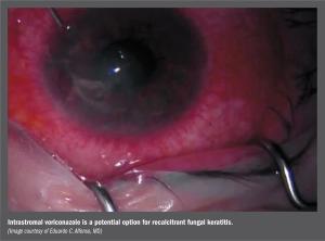 keratitis
