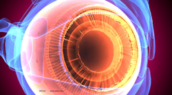 Intravitreal triamcinolone: Managing DME and increasing vision