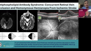 (Image credit: Ophthalmology Times) NeuroOp Guru: Eye and brain clues to antiphospholipid syndrome