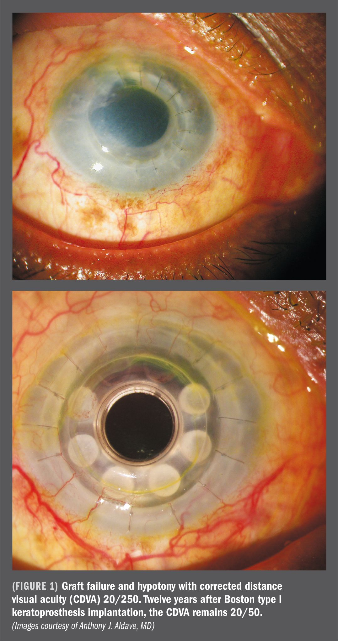Managing Repeat Transplant Failure Ophthalmology Times