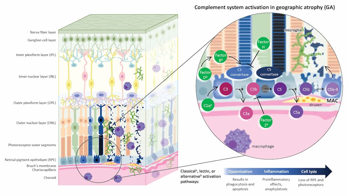 Is complement therapy the path forward for geographic atrophy?