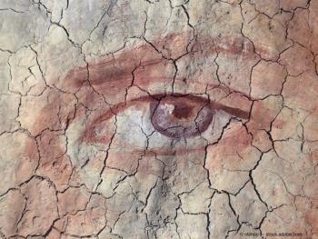 dry eye 