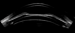 Very high–frequency ultrasound improves ICL sizing precision