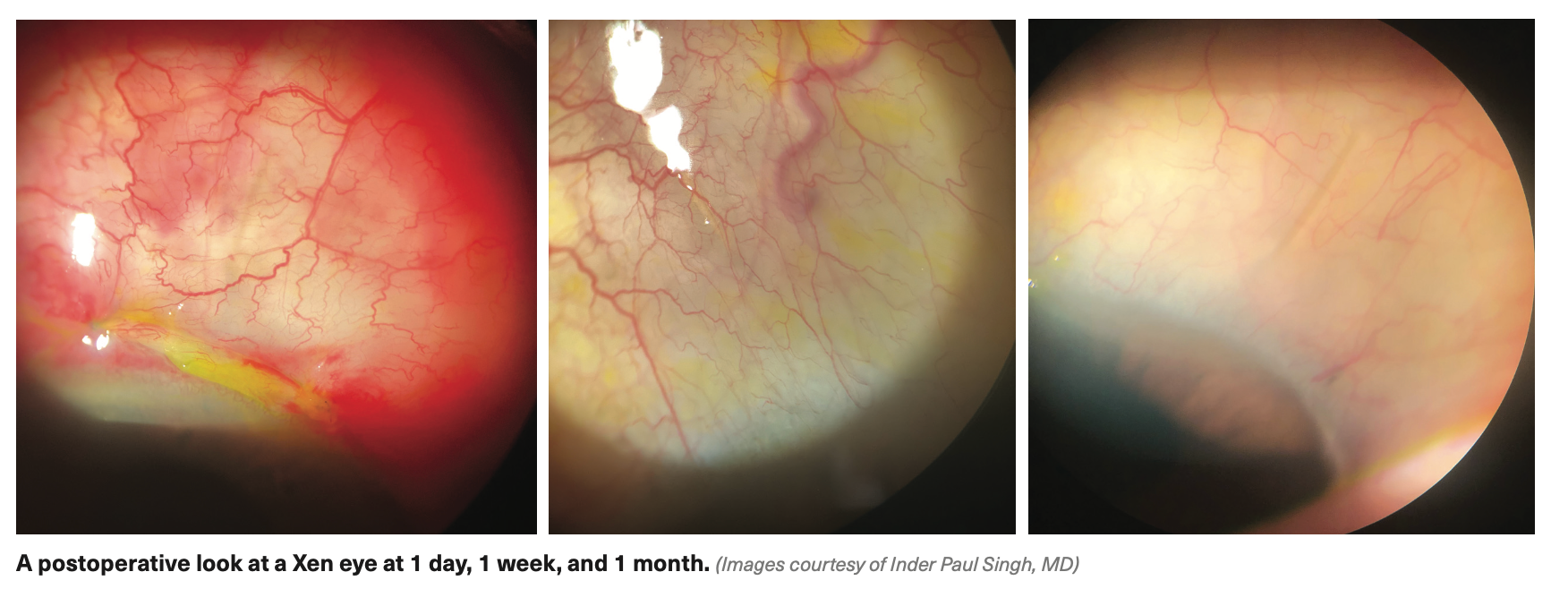 A postoperative look at a Xen eye at 1 day, 1 week, and 1 month. (Images courtesy of Inder Paul Singh, MD)