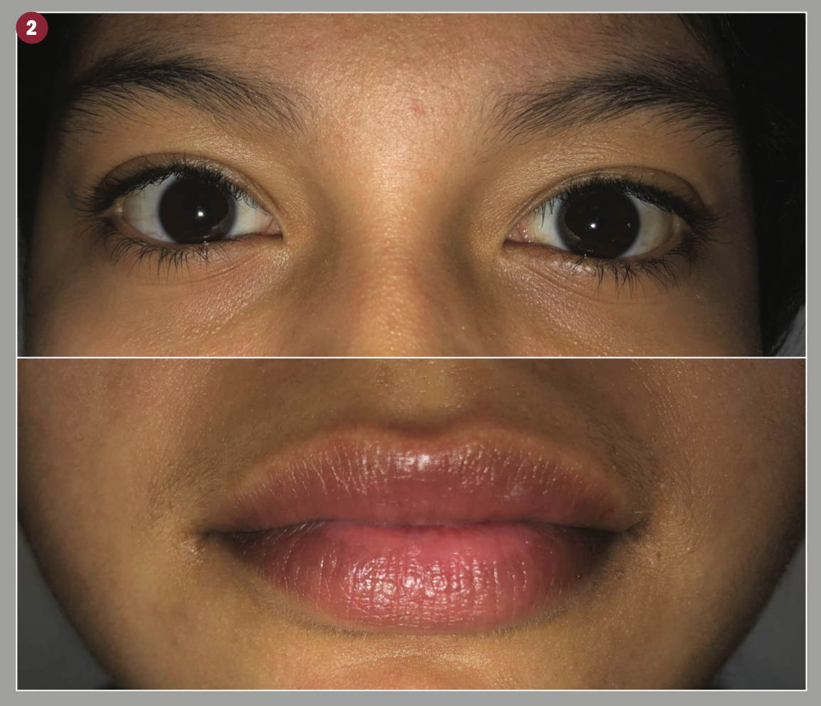 Figure 2: An external photo demonstrating complete resolution of the corneal epithelial defects, subconjunctival hemorrhages, and oral ulceration 2 months later. (Image courtesy of Haoxing Douglas Jin, MD)