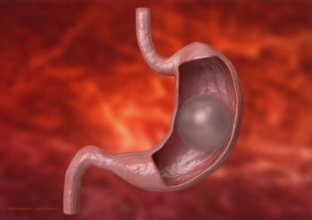 Bariatric surgery may lead to decreased risk of cataract