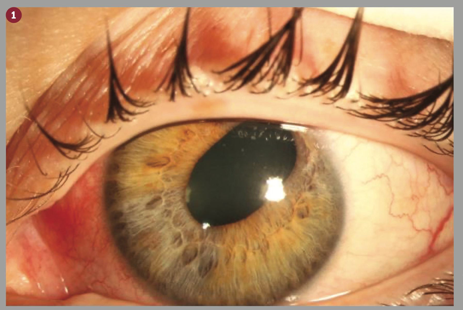 FIGURE 1. The left superotemporal pupil peaking and inferonasal iris atrophy 3 weeks after three-muscle surgery on the left eye. (Images courtesy of Olivia J. Killeen, MD)