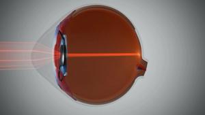 New IOLs for keratoconus and other aberrated corneas