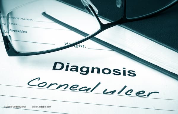 (Image credit: AdobeStock/Vitalii Vodolazskyi) Yale researchers identify corneal ulcer pathogens by testing tears