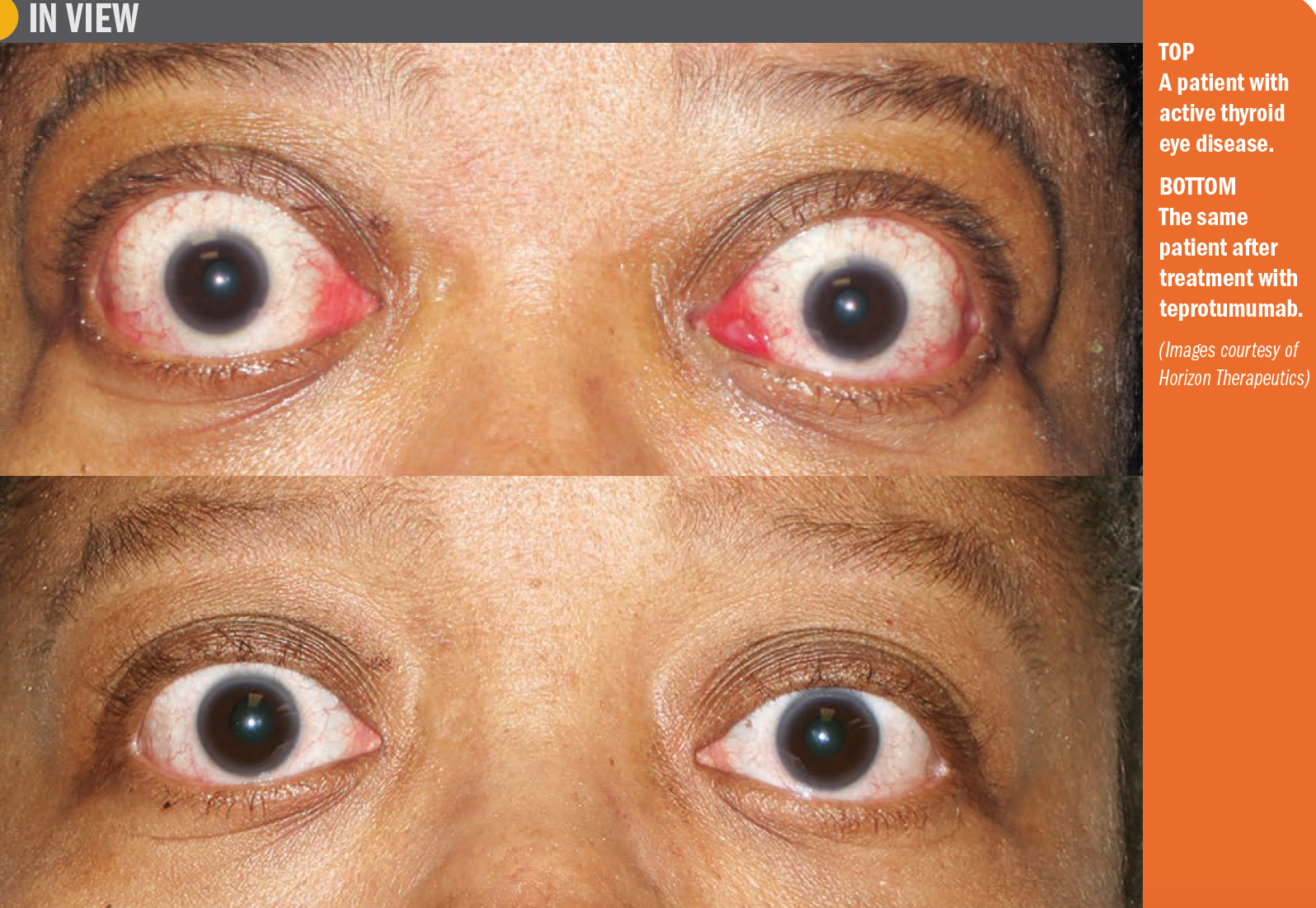 A patient with active thyroid eye disease/treated with teprotumumab
