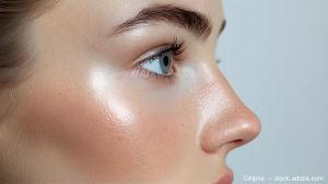 Blog: MRI findings of undereye filler and filler migration