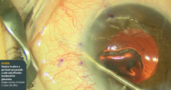 Surgery to place  gel stent provides a safe, effective treatment for glau