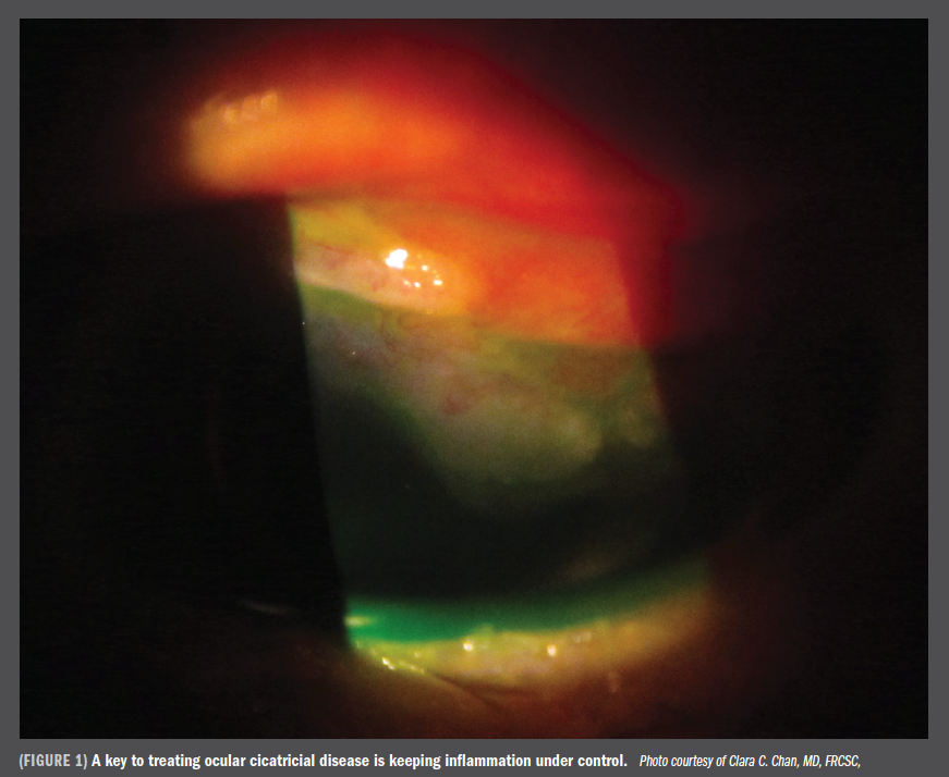 keep inflammation under control to treat ocular cicatricial disease