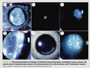 Focus on molecular mechanisms underlying cataract development