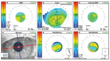 Pretreatment topography demonstrates an unstable tear film. (Photos courtesy of Cynthia Matossian, MD, FACS, ABES)