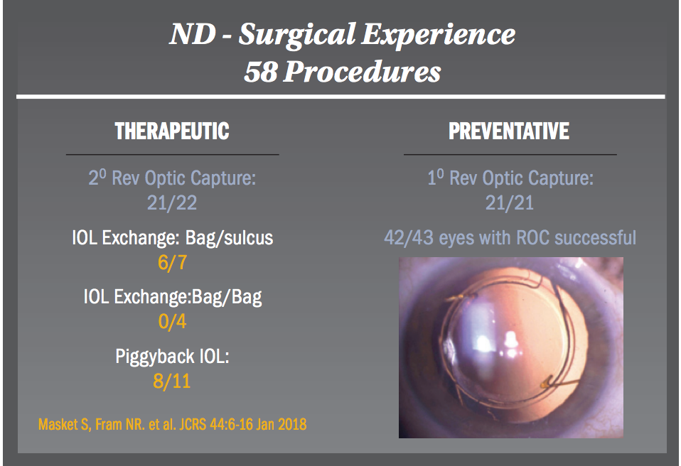 New IOL design trends avoid negative dysphotopsias