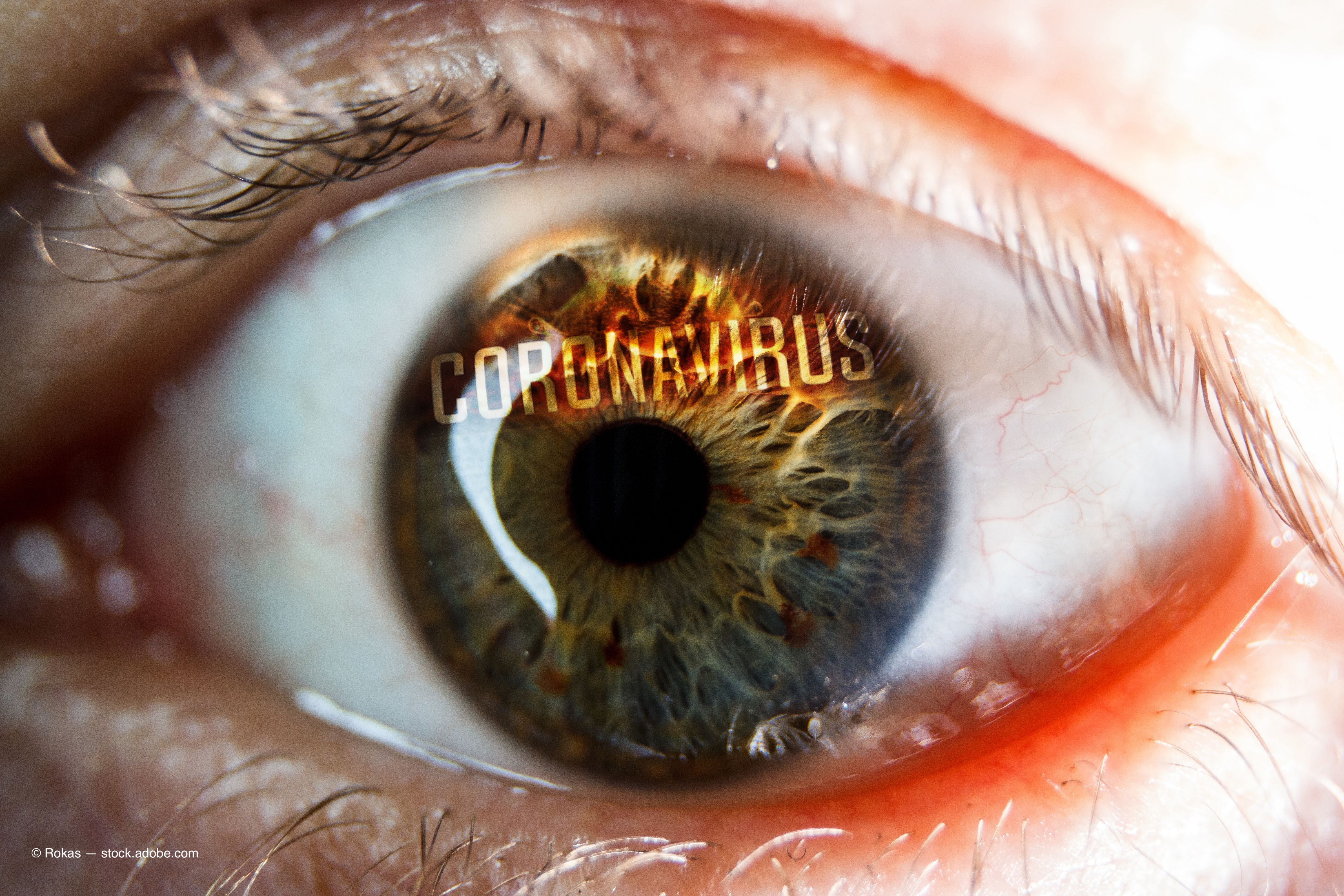 Investigators in the United Arab Emirates reported a possible association between ocular adverse events and a COVID-19 vaccination