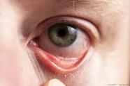 New Molecule For Allergic Conjunctivitis Makes Debut Ophthalmology Times