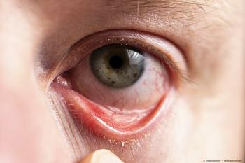 inflammed eye