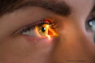Study: Accurate refractive predictions remain difficult in patients with keratoconus
