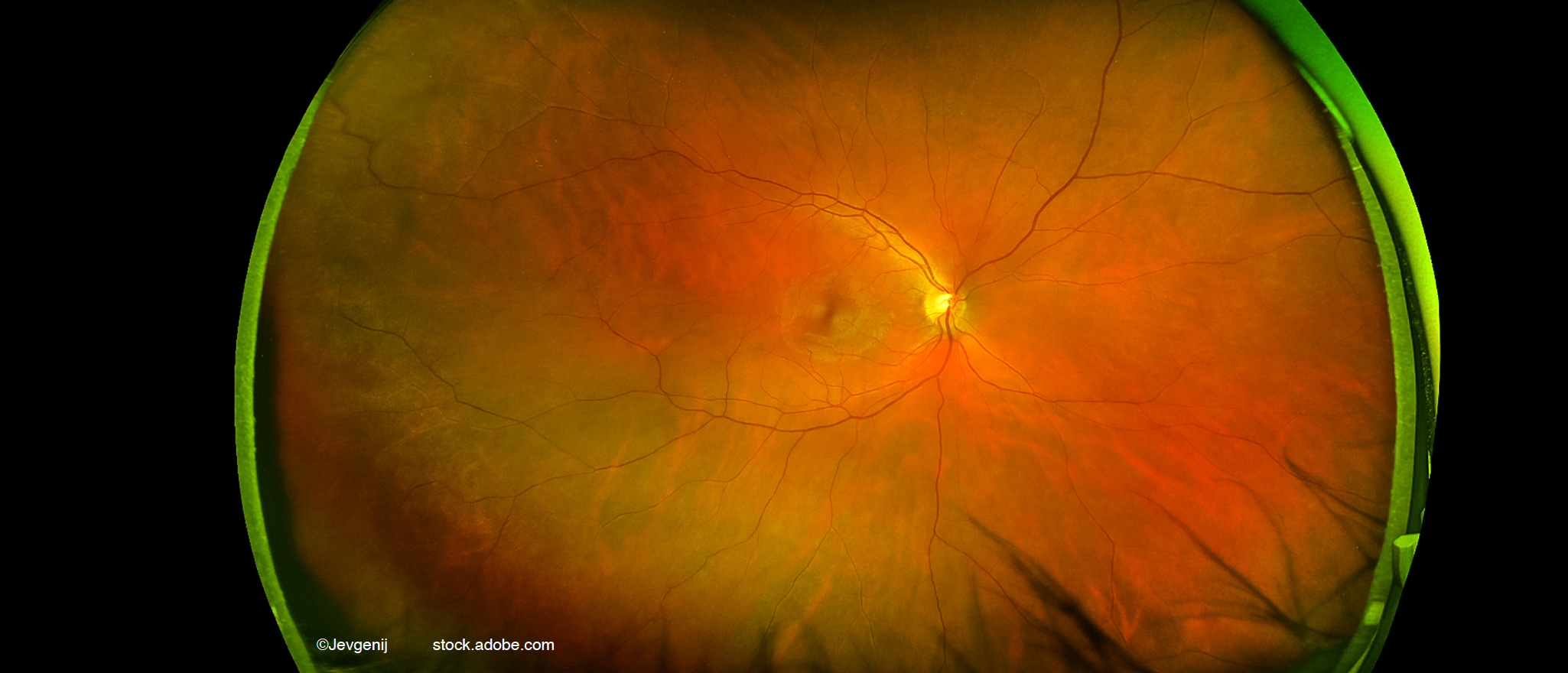 Post-hoc comparison: Ranibizumab and biosimilar showing similar efficacy in wet AMD