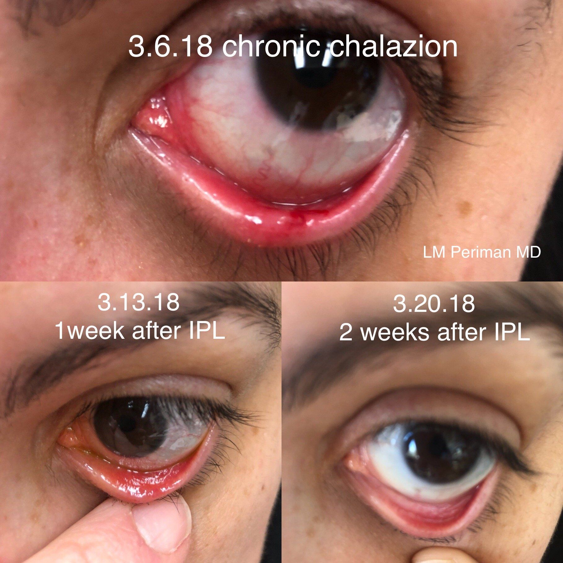 Treating Chalazion With Ipl Therapy
