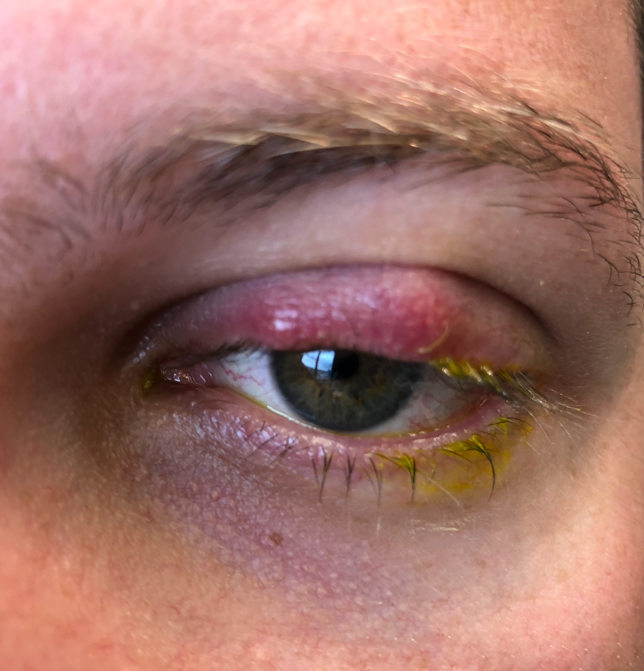 elfbar elfa kaufen Eye Discharge: Causes, Types and Treatment