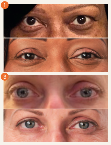 Figures 1 & 2: Before (top) and after (bottom) treatment with teprotumumab-trbw (week 24). (Images courtesy of Amgen) Figures 1 & 2: Before (top) and after (bottom) treatment with teprotumumab-trbw (week 24). (Images courtesy of Amgen)