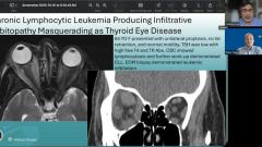 (Image credit: Andrew G. Lee, MD, and Drew Carey, MD) NeuroOp Guru: When proptosis isn’t thyroid eye disease
