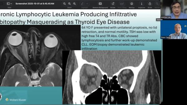 (Image credit: Andrew G. Lee, MD, and Drew Carey, MD) NeuroOp Guru: When proptosis isn’t thyroid eye disease