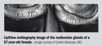 LipiView meibography image of the meibomian glands of a 57-year-old female.