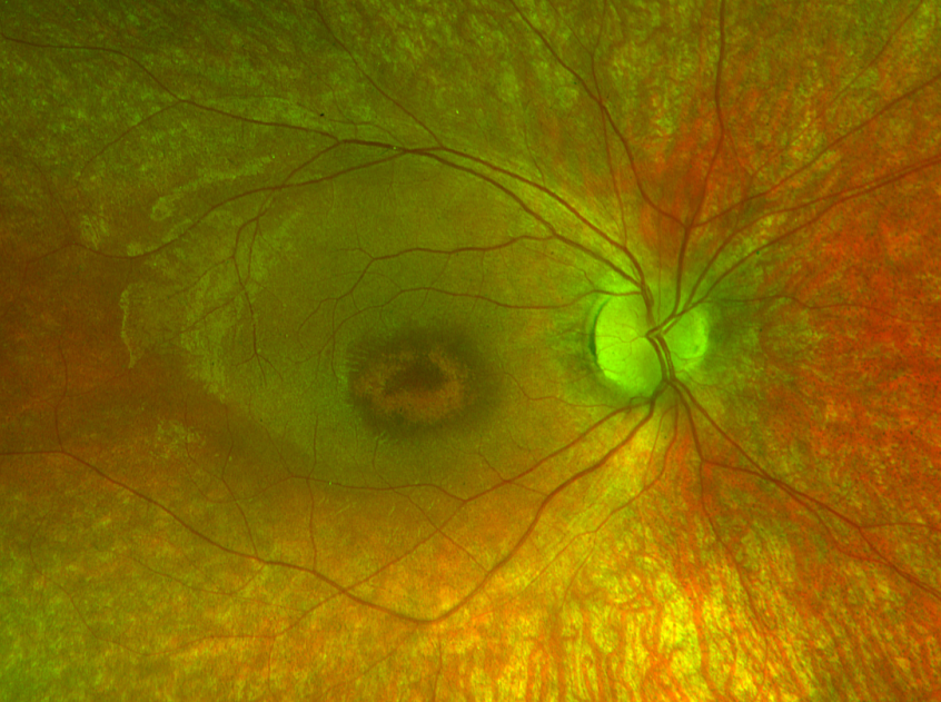 This image is a pre-treatment photo of the fundus. (Image courtesy of Friederike Kortuem, MD, MSc)