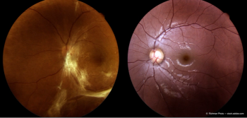 PANORAMA trial targets NPDR