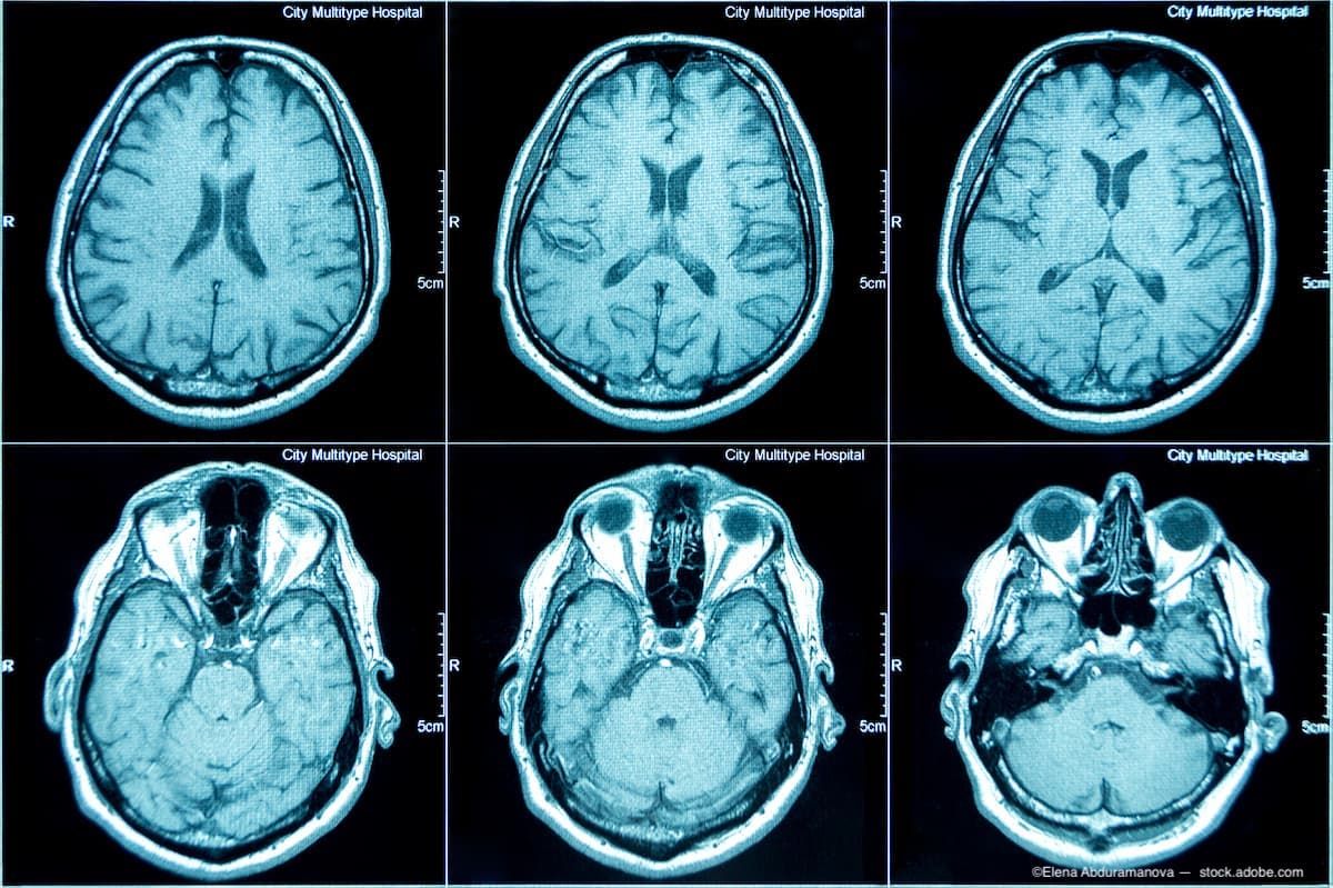 Brain Vision Track First workshop on brain-based vision disorder hosted by NEI