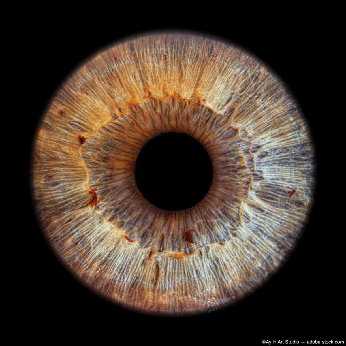 Iris freckles: Potential biomarker for AMD | Ophthalmology Times - Clinical  Insights for Eye Specialists, image size:1200x1200