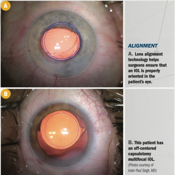for IOL placement, location is key