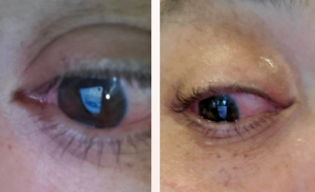 A patient's vision loss leads to another diagnosis