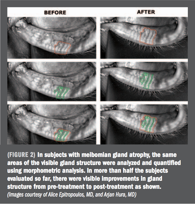 Exploring The Reversibility Of Meibomian Gland Atrophy