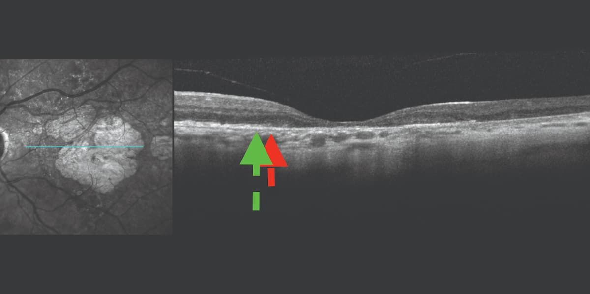 Figure 4: The Spectralis near-infrared and optical coherence tomography images demonstrate the edge of the ellipsoid zone (green arrow) compared with the edge of the retinal pigment epithelium (RPE) cell loss (red arrow). Note that the zone of photoreceptor cell loss is larger than the zone of RPE loss. This is characteristic of progressive geographic atrophy. (All figures courtesy of Jeremiah Brown Jr, MD, MS, FASRS) Figure 4: The Spectralis near-infrared and optical coherence tomography images demonstrate the edge of the ellipsoid zone (green arrow) compared with the edge of the retinal pigment epithelium (RPE) cell loss (red arrow). Note that the zone of photoreceptor cell loss is larger than the zone of RPE loss. This is characteristic of progressive geographic atrophy. (All figures courtesy of Jeremiah Brown Jr, MD, MS, FASRS)