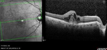 ASRS LIVE: TRUCKEE Study shows real-world safety and efficacy of faricimab for neovascular AMD