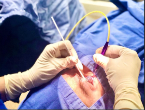 Transscleral laser therapy device simplifies procedure