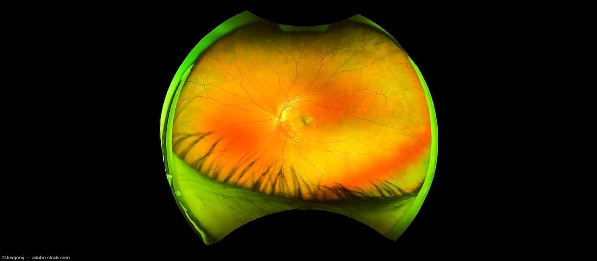 Untangling the neurovascular clues in the retinas of patients with Parkinson disease 